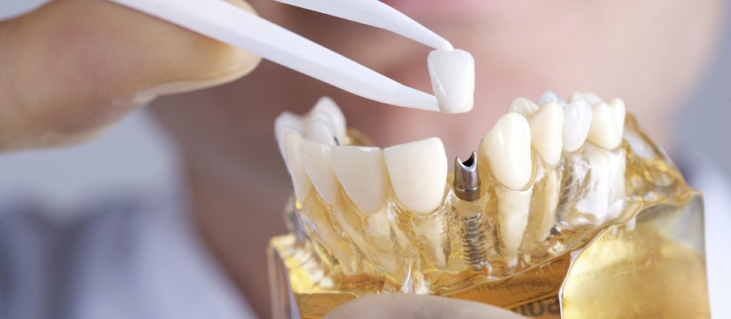 Dental Implants | Dr Lovit DMD Columbia SC