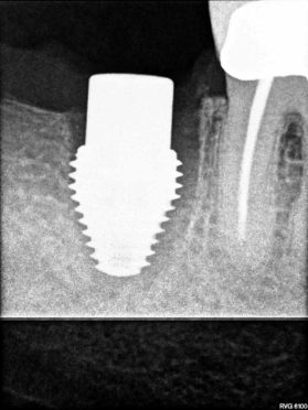 Dental Implant Side