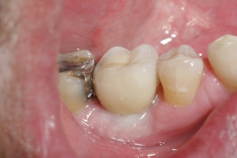 South Carolina Dental Implant