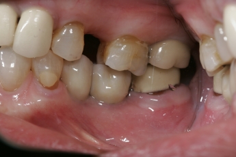 dental implant example in columbia sc