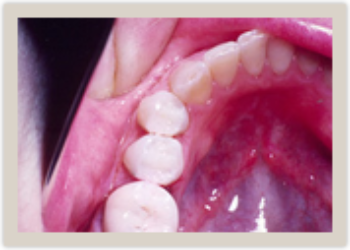 Columbia SC Dental Fillings After